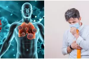 Kerap disepelekan, ternyata ini 8 faktor risiko alami tuberkulosis (TBC) di usia muda