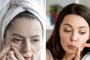 Bisakah hilangkan milia di wajah hanya pakai skincare? Ini penjelasan lengkap dengan langkahnya