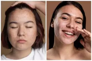 Bisa picu inflamasi, 11 kandungan skincare yang harus dihindari kulit berjerawat yang wajib diketahui
