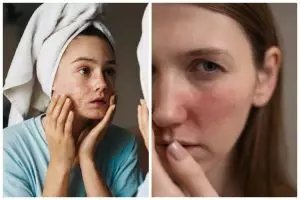 Kenapa setelah pakai skincare muka terasa panas? Ketahui 7 penyebab dan cara mengatasinya
