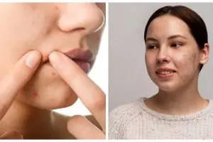 7 Ciri-ciri jerawat karena tidak cocok skincare dan cara mengatasinya auto kulit tenang kembali