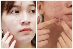 9 Produk skincare di Indomaret untuk kulit berminyak dan jerawatan terbaru di bawah Rp 150 ribu