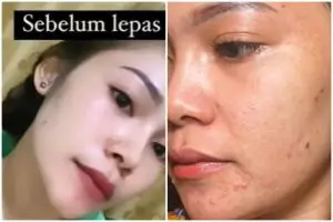 Kisah perjuangan cewek lepas dari krim dokter, efeknya bikin kapok pakai skincare mengandung steroid