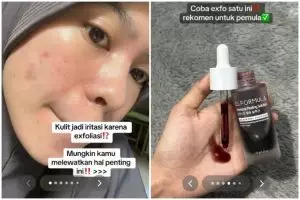 Jangan asal, cewek ini bagikan cara eksfoliasi wajah yang tepat agar kulit antiiritasi