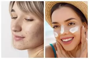Kulit berjerawat seharusnya pakai sunscreen SPF berapa? Simak penjelasannya biar wajah nggak break out