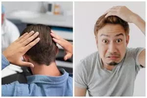 Diklaim bisa pulihkan rambut rontok, simak fakta-fakta PRP hair treatment