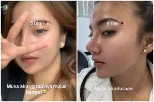Asalnya punya wajah mulus, perubahan kulit cewek usai pakai skincare nggak cocok ini bikin miris