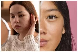 7 Bahan aktif dan rekomendasi skincare untuk mengatasi bekas jerawat PIE ini bikin kulit halus