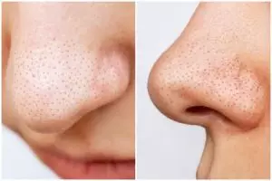 Produk pelembap ini bisa atasi komedo membandel di hidung, begini cara pakainya