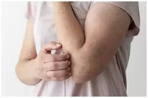 Bisa bikin jadi tambah parah, 9 makanan ini tak boleh dikonsumsi penderita cacar monyet