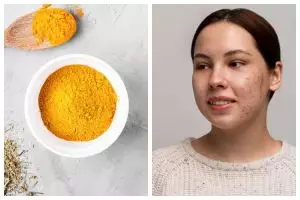 Diklaim bisa atasi jerawat, simak penjelasan pemakaian temulawak pada wajah