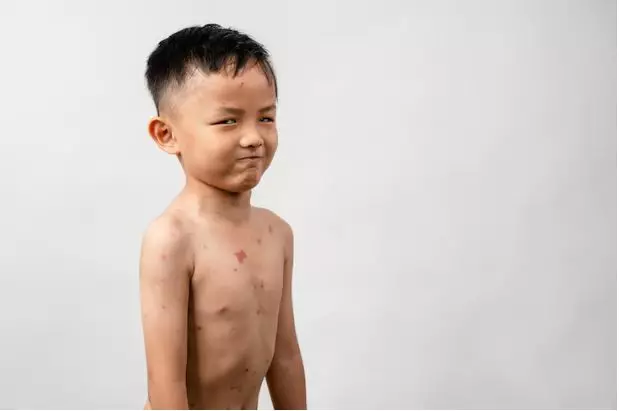 Alasan jagung parut bahaya untuk penderita cacar freepik.com Alasan jagung parut bahaya untuk penderita cacar freepik.com