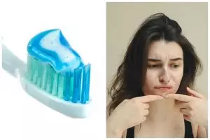 [KUIS] Benar atau salah: pasta gigi dapat mengobati jerawat? Cek faktanya lewat pertanyaan ini