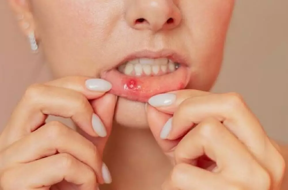 cara menyembuhkan sariawan freepik.com