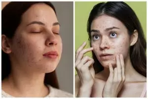 9 Produk skincare untuk bruntusan di jidat harga di bawah Rp150 ribu, auto bikin kulit halus