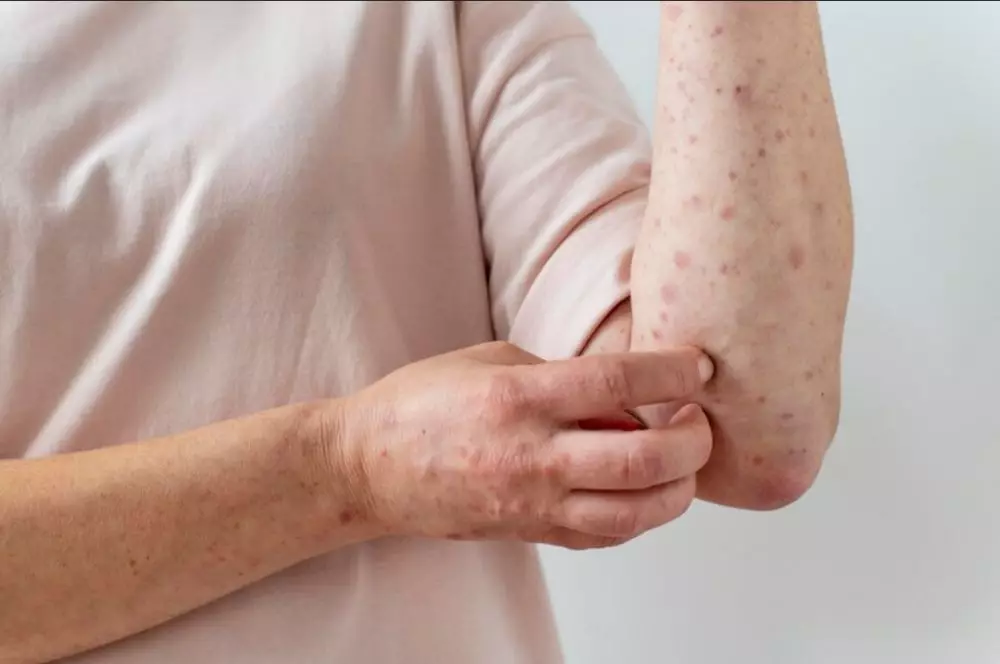 menghilangkan bekas cacar berbagai sumber menghilangkan bekas cacar berbagai sumber