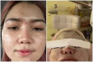 Bukti beauty is pain, cewek ini bagikan perubahan wajahnya sebelum dan usai treatment facial peeling