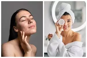 9 Cara menghilangkan jerawat tanpa skincare, andalkan bahan alami ini untuk kulit halus