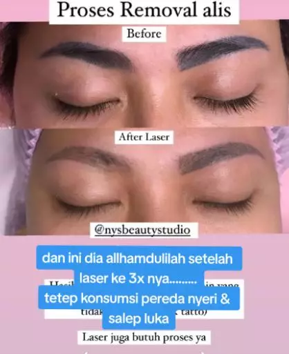 Cewek bagikan kisah sulam alis gagal dan perjuangan laser alis TikTok