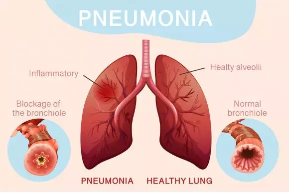 kenali gejala awal paru-paru basa © 2024 brilio.net
