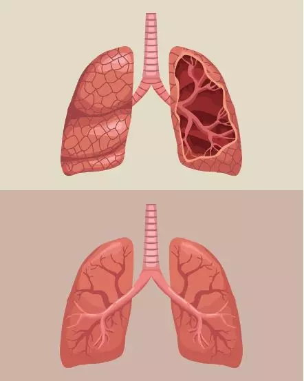 kenali gejala awal paru-paru basa © 2024 brilio.net