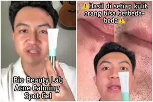 Review Bio Beauty Lab Acne Spot Gel diklaim bisa redakan jerawat dalam 5 jam, bikin perih nggak?
