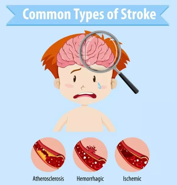 Apa itu stroke iskemik © 2024 brilio.net Apa itu stroke iskemik © 2024 brilio.net