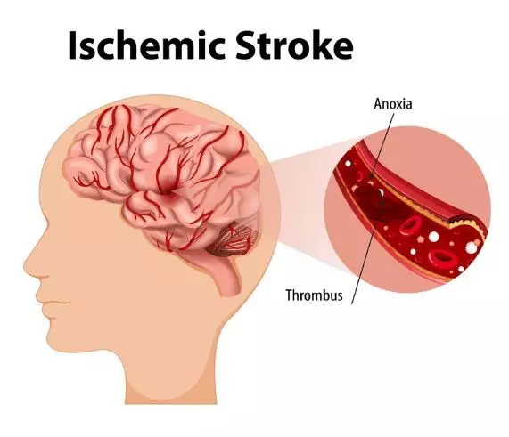 Apa itu stroke iskemik © 2024 brilio.net Apa itu stroke iskemik © 2024 brilio.net