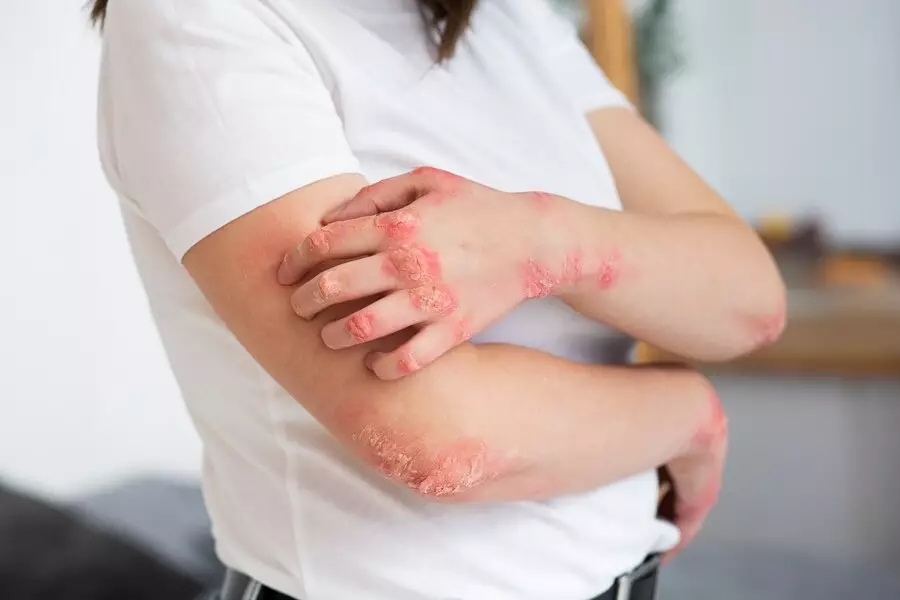 risiko kesehatan akibat psoriasis © 2024 freepik.com risiko kesehatan akibat psoriasis © 2024 freepik.com