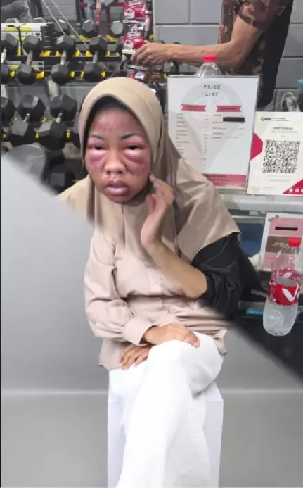 Viral potret cewek berwajah bengep karena ketimpa barbel 1 kg TikTok/@heiteya Viral potret cewek berwajah bengep karena ketimpa barbel 1 kg TikTok/@heiteya