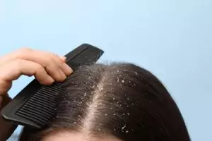 Tanpa tambahan air lemon dan kopi, trik hilangkan ketombe membandel ini cuma andalkan 1 bahan dapur