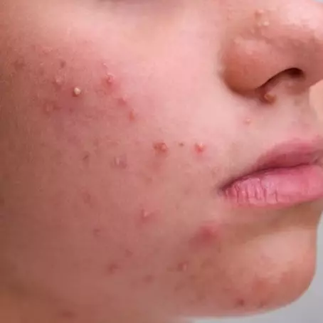 Bahan pembuat kue ini ternyata efektif bikin jerawat meradang cepat kering, begini cara pakainya