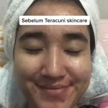 Berhenti gunakan skincare langganan, wajah mulus cewek ini malah berujung breakout parah