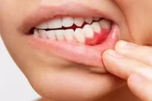 Cara ampuh hilangkan karang gigi agar tak makin parah hanya pakai 1 bahan rempah, gigi auto kinclong