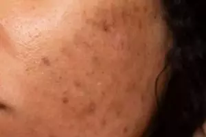 Trik hilangkan flek hitam membandel di wajah, hilang tak bersisa pakai 1 jenis bahan pemanis