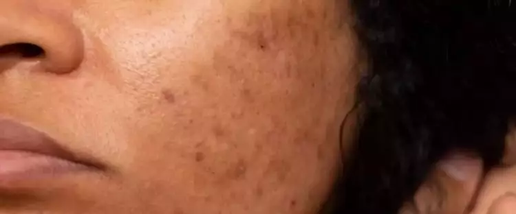 Trik hilangkan flek hitam membandel di wajah, hilang tak bersisa pakai 1 jenis bahan pemanis