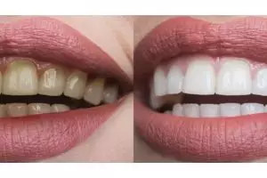 Trik hilangkan plak di gigi pakai 1 jenis bumbu dapur, auto putih cemerlang bak di-bleaching