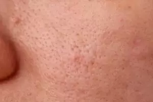 Cara atasi pori-pori besar dengan 1 jenis bahan kue, ampuh meski tanpa kunyit dan kopi