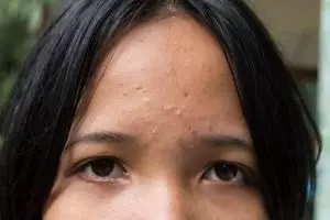 Tepung beras dicampur 2 bahan dapur ini bisa atasi fungal acne, begini cara meraciknya