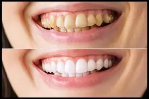 Cara menghilangkan noda kuning membandel pada gigi, ampuh cuma andalkan 1 bahan minuman rempah