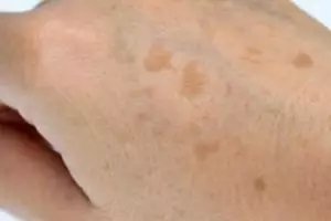 Cara ratakan warna kulit tangan tanpa perlu beli lulur, hilang belang pakai 1 bumbu dapur