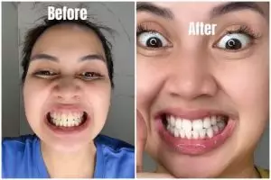 Review pasta gigi bubuk MeToo Teeth Probiotic diklaim mampu putihkan gigi kuning dalam sekali pakai