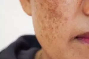 Cara putihkan kulit dari flek hitam cuma andalkan 2 minuman, hasilnya dikira tetangga suntik putih