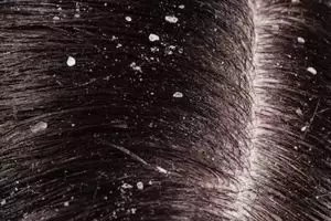 Trik mudah merontokkan ketombe tanpa lidah buaya, ampuh cuma andalkan 1 jenis minuman