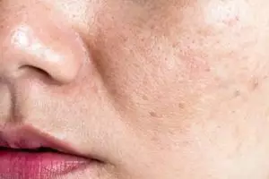 Trik cerahkan flek hitam dan wajah kusam, ampuh cuma andalkan 1 jenis buah-buahan