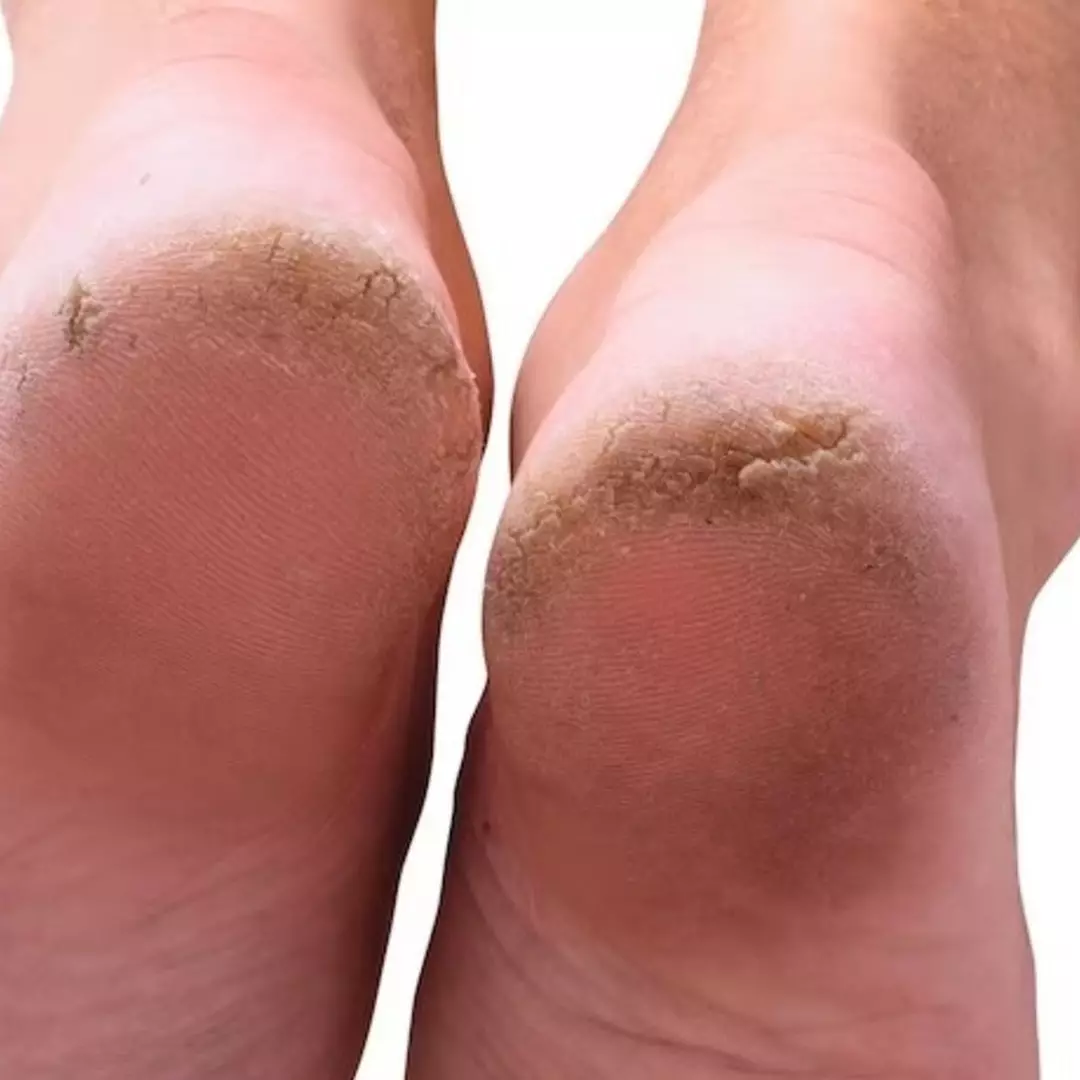 Trik hilangkan tumit kaki pecah-pecah tanpa petroleum jelly, ampuh cuma andalkan 1 jenis lilin