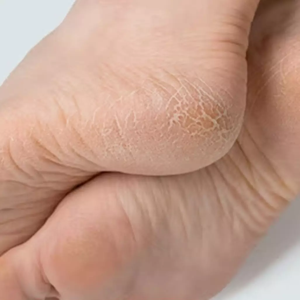 Trik haluskan tumit kaki retak menghitam, hasilnya terlihat dalam satu malam andalkan 2 bahan dapur