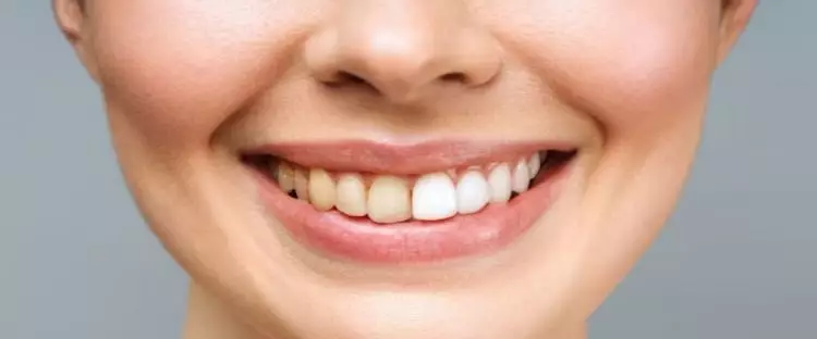 Trik memutihkan gigi penuh plak, ampuh cuma andalkan 2 jenis buah-buahan