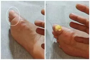 Cara alami menghilangkan mata ikan di telapak kaki ini ampuh cuma pakai 1 bahan dapur