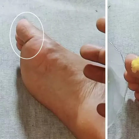 Cara alami menghilangkan mata ikan di telapak kaki ini ampuh cuma pakai 1 bahan dapur